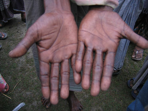 ヒ素中毒症の症状が出ている住民の手（クスティア県ナウダケメディアル村）