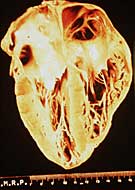 Una muestra de corazón afectado de la Enfermedad de Chagas.